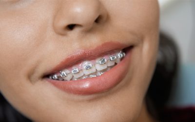 How to Prevent your Child Needing Braces