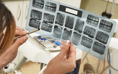 Dental X-Ray Check Ups: What They Are and How Often Do You Need Them