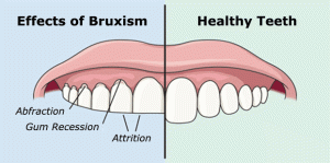 bruxism and tinnitus