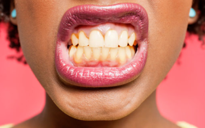 Why Are My Teeth So Yellow? Common Causes And Simple Cures