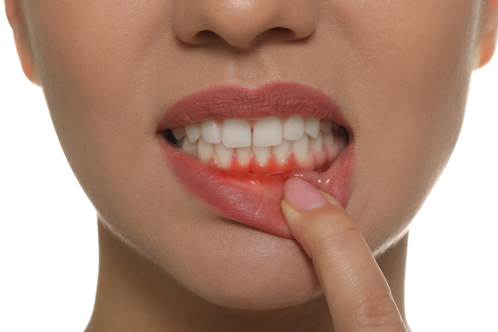 Can thin gums cause receding gums?