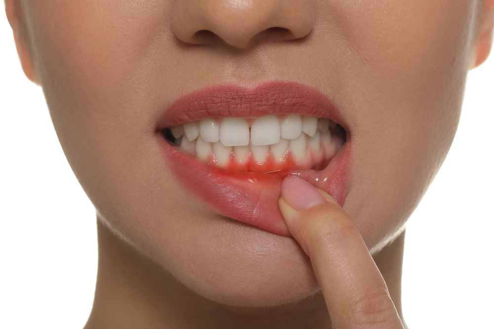 Can Thin Gums Cause Receding Gums Bloor West High Park Dental Clinic