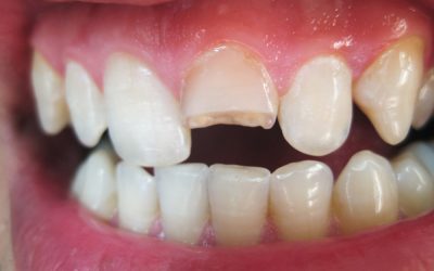 Wat to do if you have a chipped tooth?