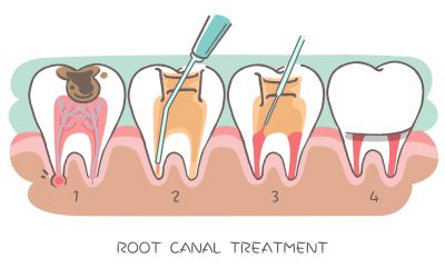 Will you definitely need a crown after a root canal? 