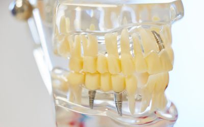 Dental Implants and Dentures: A Quick Guide to Help You Choose! 