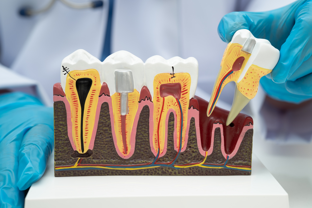 Concpt of tooth extraction