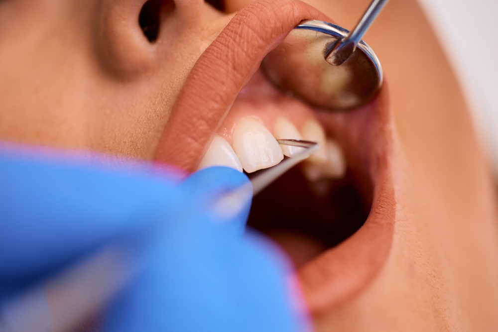 Mouth examination for teeth cleaning