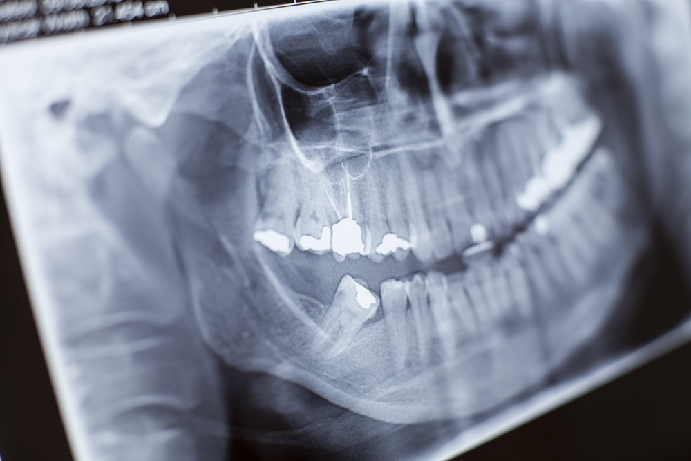 Tooth X ray